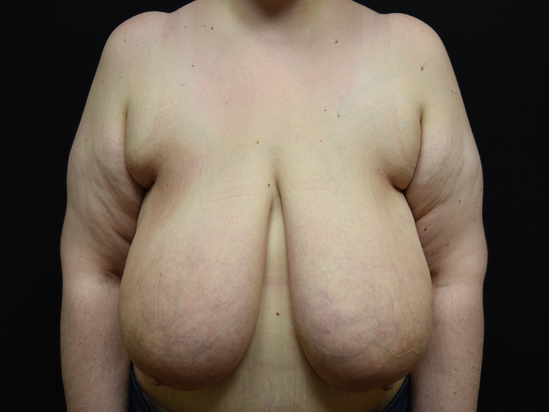 Breast Reduction