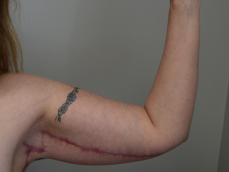 Arm Lift Before and After | Dr. Nadeau - Plastic and Reconstructive Surgeon