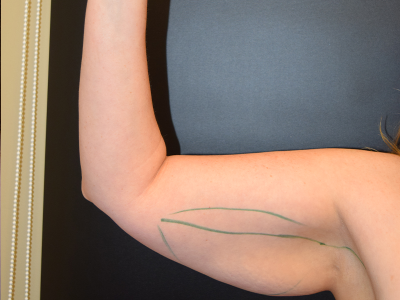 Arm Lift Before and After | Dr. Nadeau - Plastic and Reconstructive Surgeon