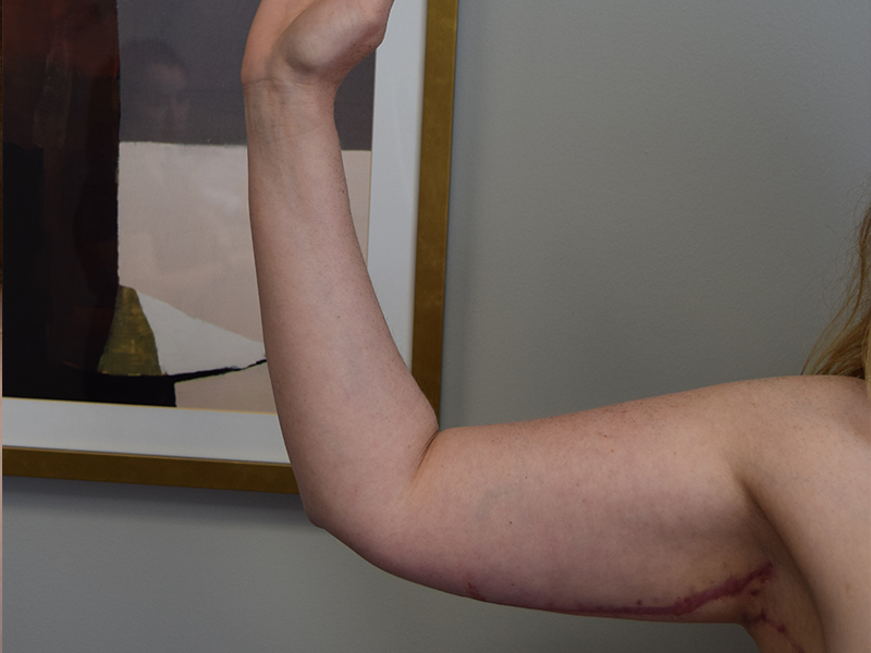 Arm Lift Before and After | Dr. Nadeau - Plastic and Reconstructive Surgeon