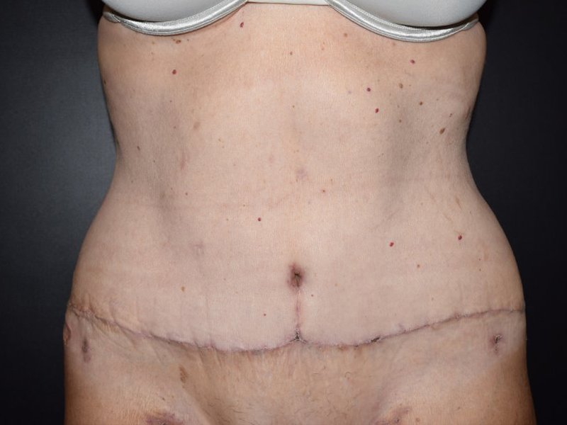 Body Lift Before and After | Dr. Nadeau - Plastic and Reconstructive Surgeon