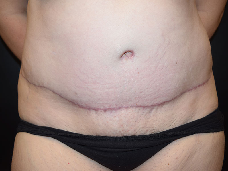 Female Abdominoplasty Before and After | Dr. Nadeau - Plastic and Reconstructive Surgeon