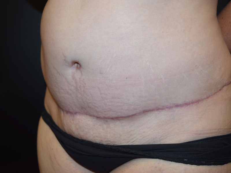 Female Abdominoplasty Before and After | Dr. Nadeau - Plastic and Reconstructive Surgeon