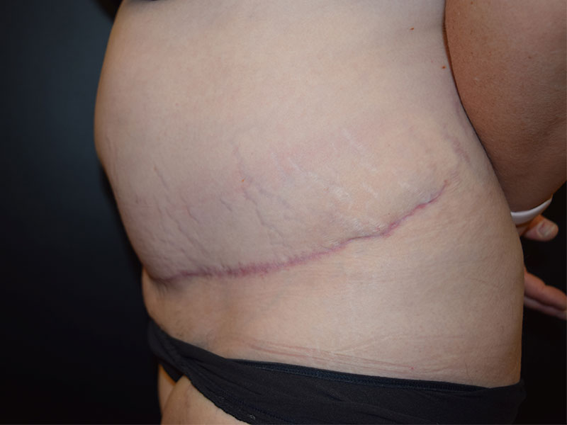 Female Abdominoplasty Before and After | Dr. Nadeau - Plastic and Reconstructive Surgeon