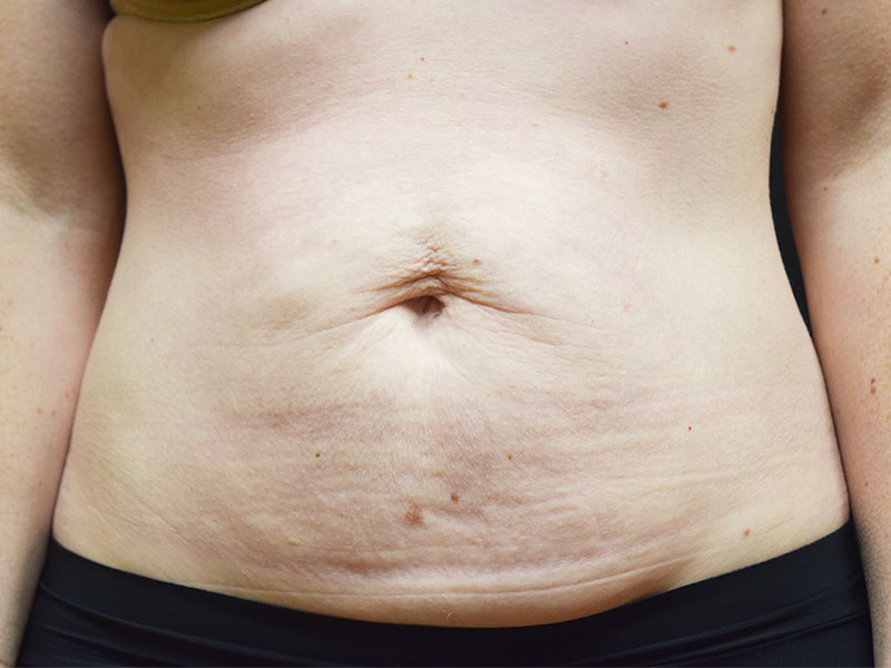 Female Abdominoplasty Before and After | Dr. Nadeau - Plastic and Reconstructive Surgeon