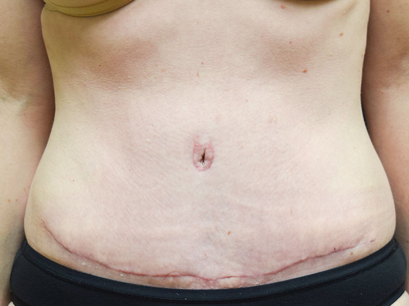 Female Abdominoplasty Before and After | Dr. Nadeau - Plastic and Reconstructive Surgeon