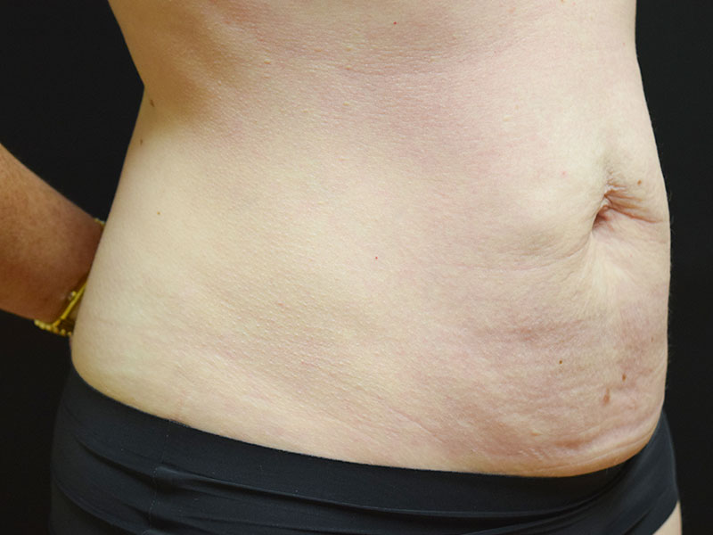 Female Abdominoplasty Before and After | Dr. Nadeau - Plastic and Reconstructive Surgeon