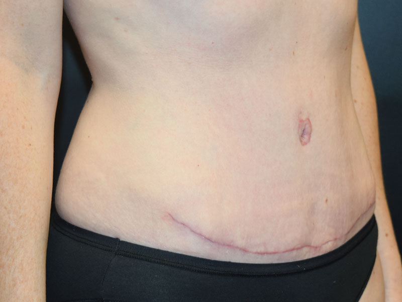 Female Abdominoplasty Before and After | Dr. Nadeau - Plastic and Reconstructive Surgeon