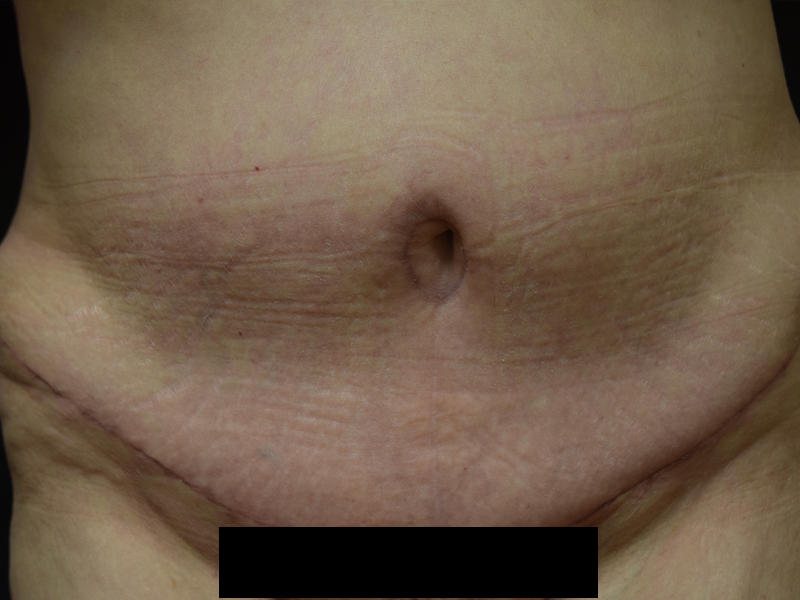 Female Abdominoplasty Before and After | Dr. Nadeau - Plastic and Reconstructive Surgeon