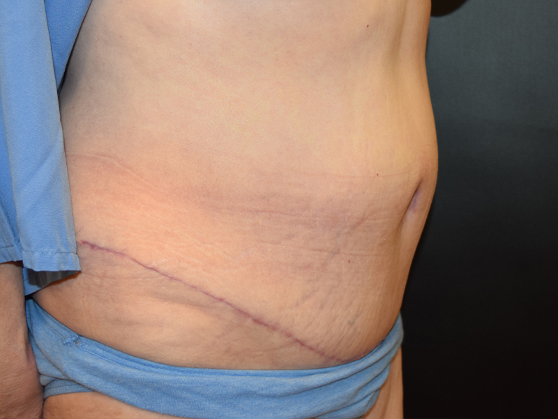 Female Abdominoplasty Before and After | Dr. Nadeau - Plastic and Reconstructive Surgeon