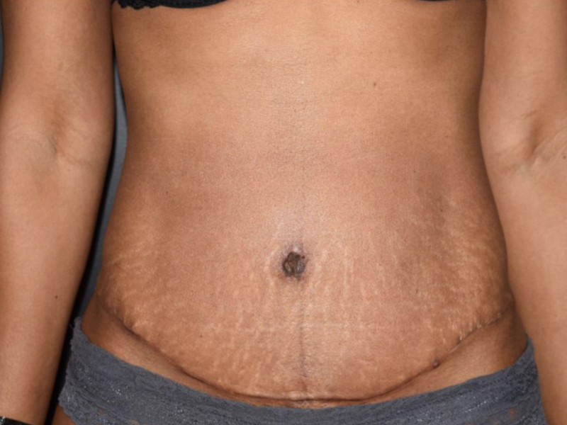 Female Abdominoplasty Before and After | Dr. Nadeau - Plastic and Reconstructive Surgeon