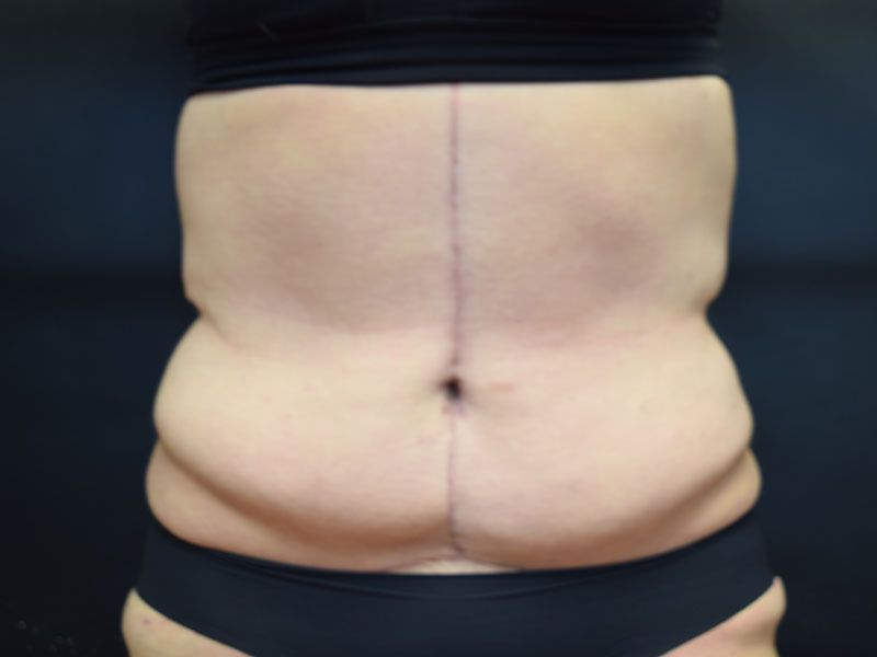 Female Abdominoplasty Before and After | Dr. Nadeau - Plastic and Reconstructive Surgeon