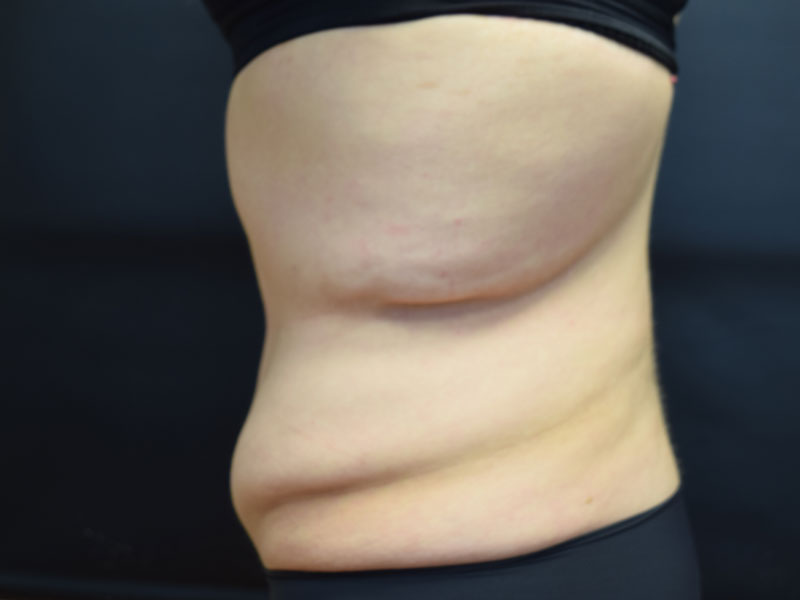 Female Abdominoplasty Before and After | Dr. Nadeau - Plastic and Reconstructive Surgeon