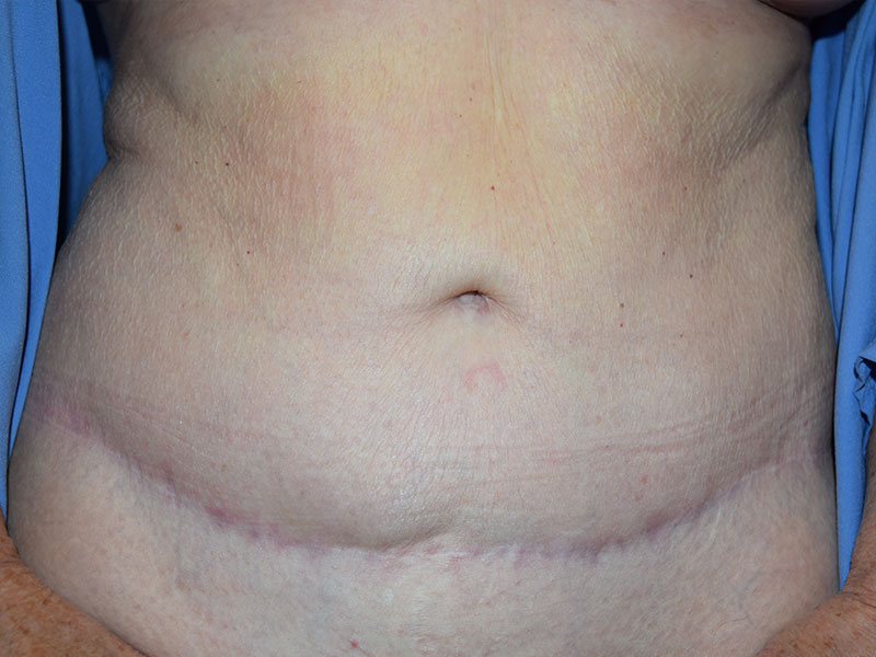 Female Abdominoplasty Before and After | Dr. Nadeau - Plastic and Reconstructive Surgeon