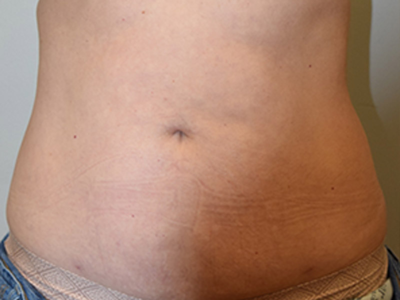 Liposuction Before and After | Dr. Nadeau - Plastic and Reconstructive Surgeon