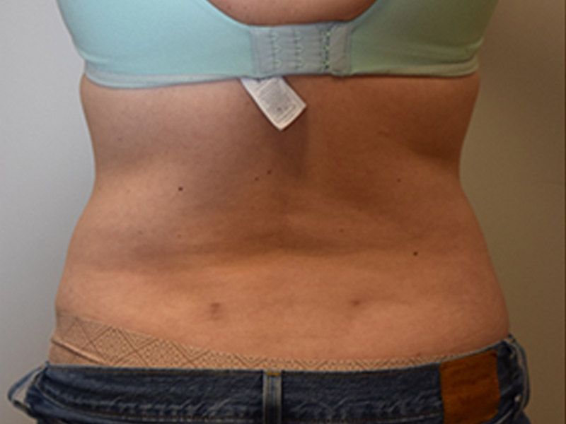 Liposuction Before and After | Dr. Nadeau - Plastic and Reconstructive Surgeon