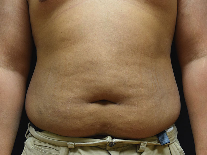 Male Abdominoplasty Before and After | Dr. Nadeau - Plastic and Reconstructive Surgeon
