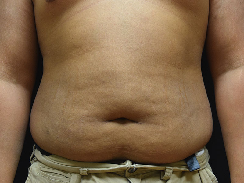 Seattle abdominoplasty patient before