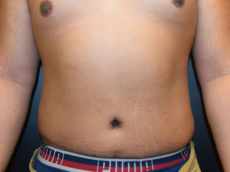 Seattle abdominoplasty patient after