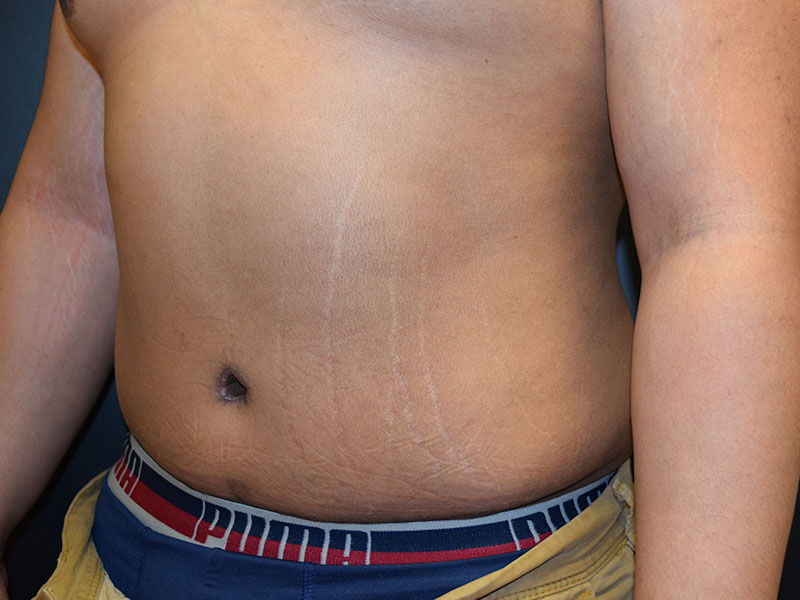 Male Abdominoplasty Before and After | Dr. Nadeau - Plastic and Reconstructive Surgeon