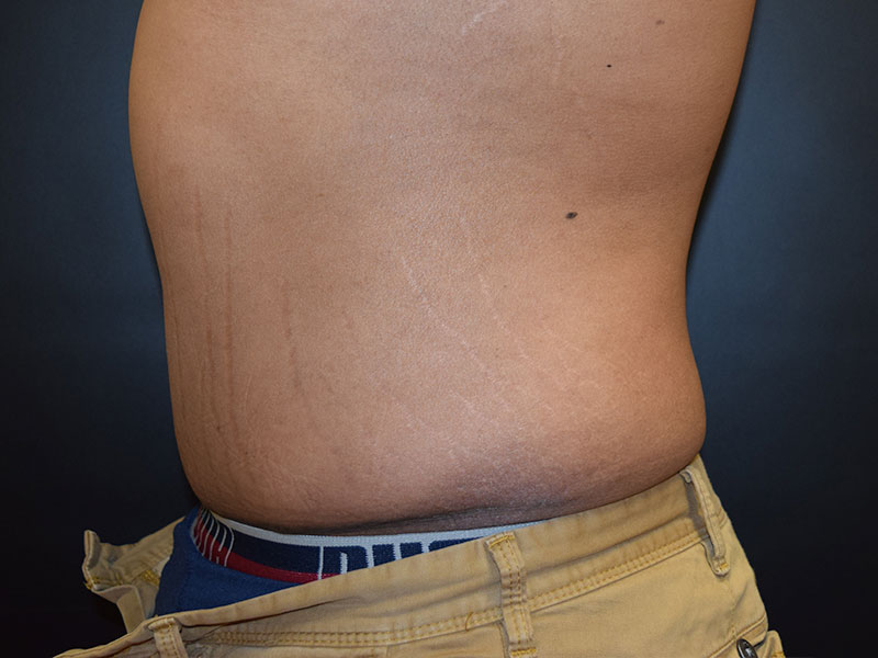 Male Abdominoplasty Before and After | Dr. Nadeau - Plastic and Reconstructive Surgeon