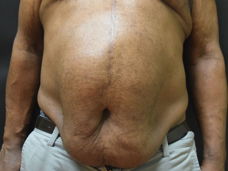 Male Abdominoplasty Before and After | Dr. Nadeau - Plastic and Reconstructive Surgeon