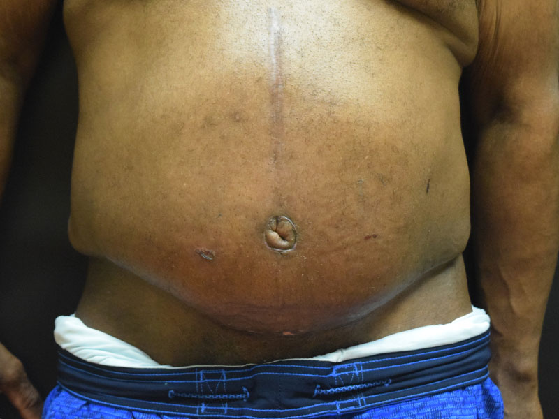 Male Abdominoplasty Before and After | Dr. Nadeau - Plastic and Reconstructive Surgeon