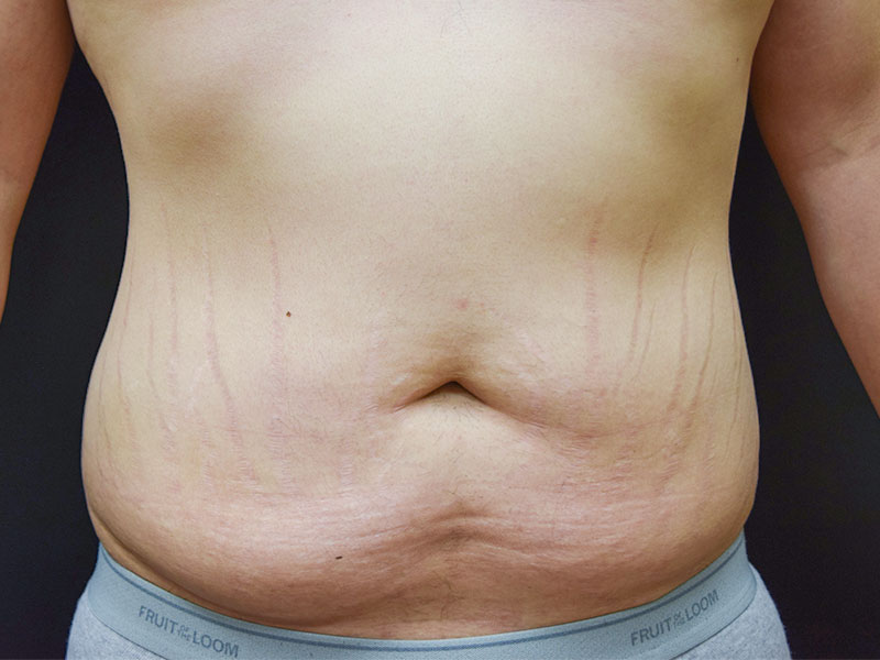 Male Abdominoplasty Before and After | Dr. Nadeau - Plastic and Reconstructive Surgeon