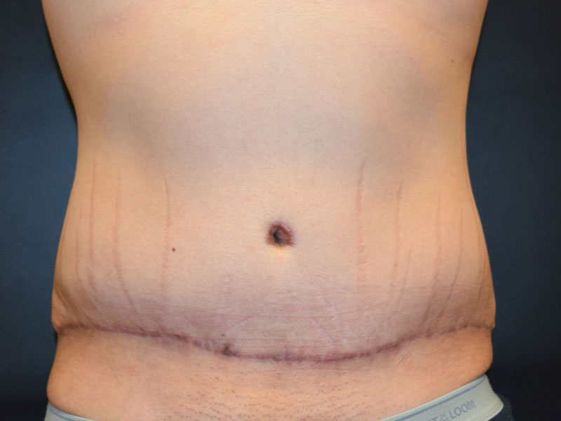 Male Abdominoplasty Before and After | Dr. Nadeau - Plastic and Reconstructive Surgeon