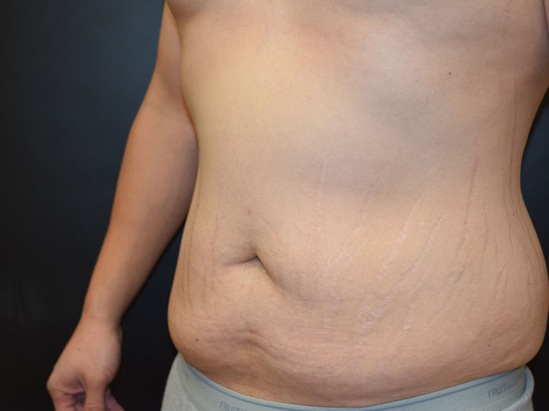 Male Abdominoplasty Before and After | Dr. Nadeau - Plastic and Reconstructive Surgeon