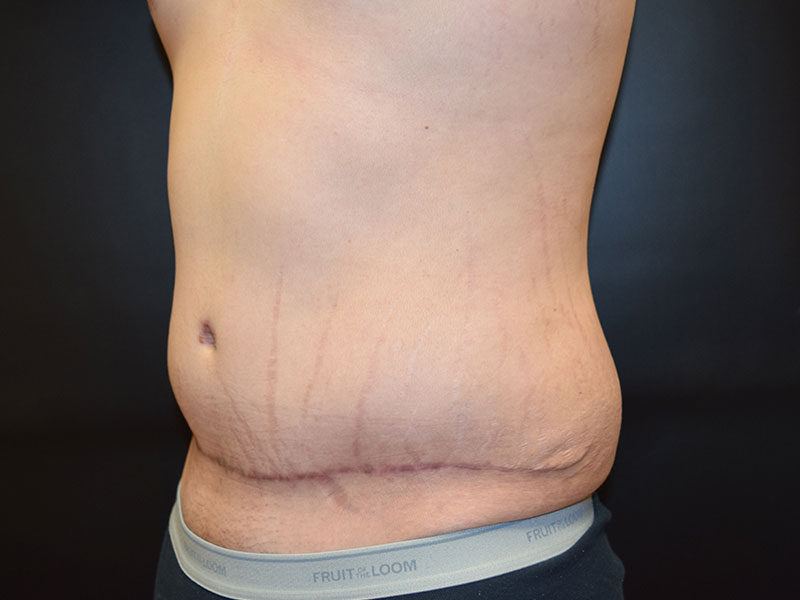 Male Abdominoplasty Before and After | Dr. Nadeau - Plastic and Reconstructive Surgeon