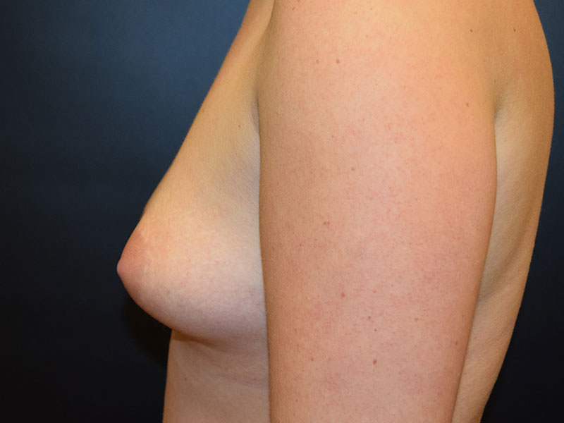Breast Augmentation Before and After | Dr. Nadeau - Plastic and Reconstructive Surgeon