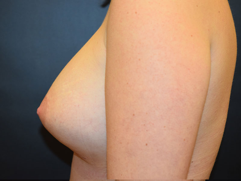 Breast Augmentation Before and After | Dr. Nadeau - Plastic and Reconstructive Surgeon