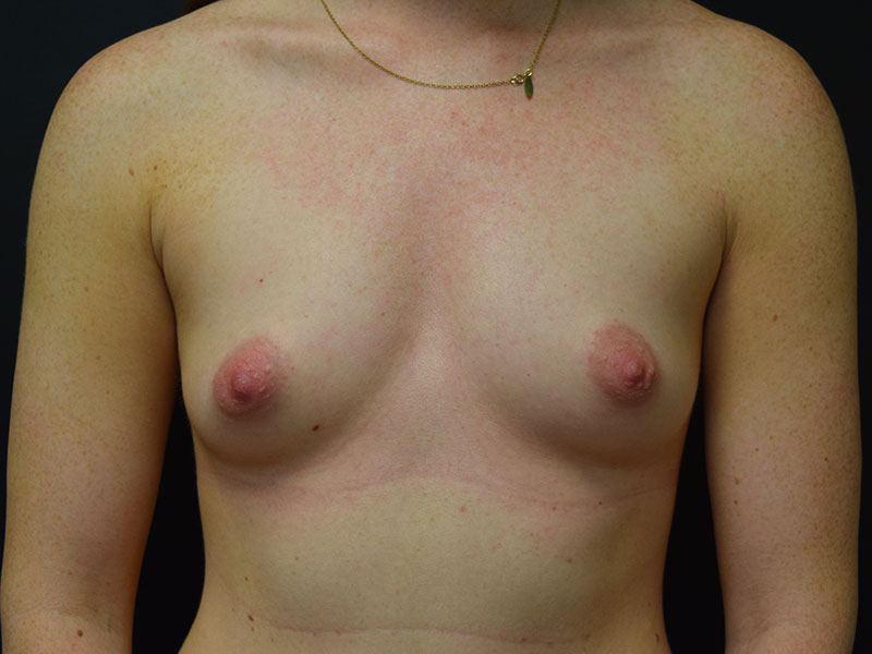 Breast Augmentation Before and After | Dr. Nadeau - Plastic and Reconstructive Surgeon