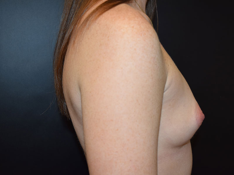 Breast Augmentation Before and After | Dr. Nadeau - Plastic and Reconstructive Surgeon