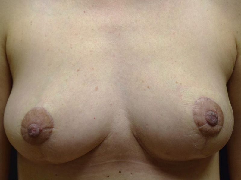 Before and After Breast Lift in Seattle