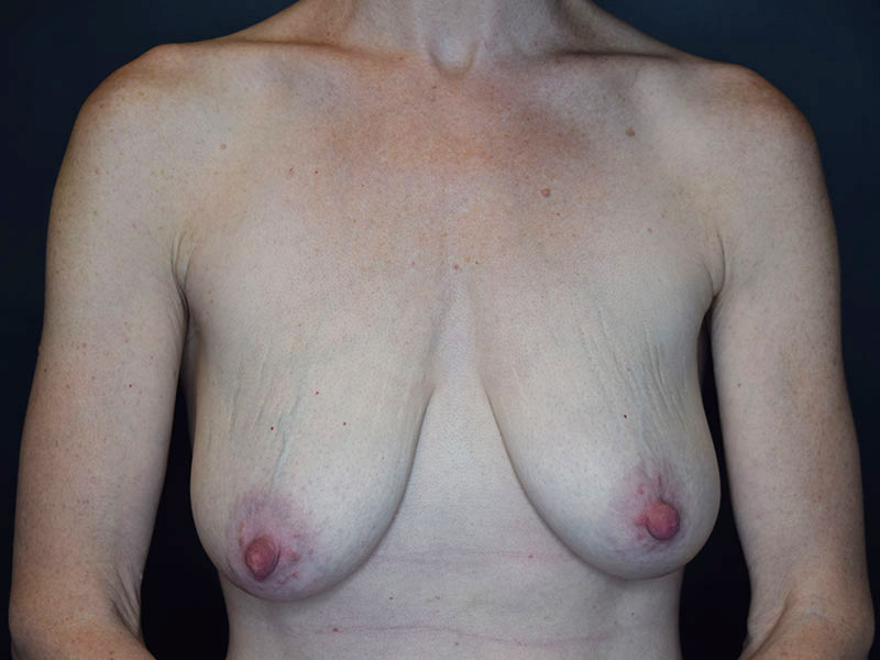 Before and After Breast Lift in Seattle