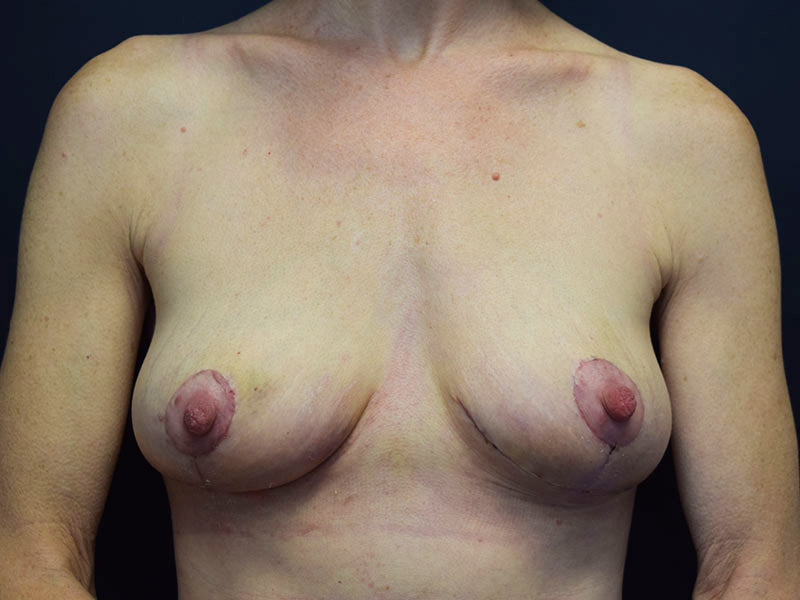 Before and After Breast Lift in Seattle