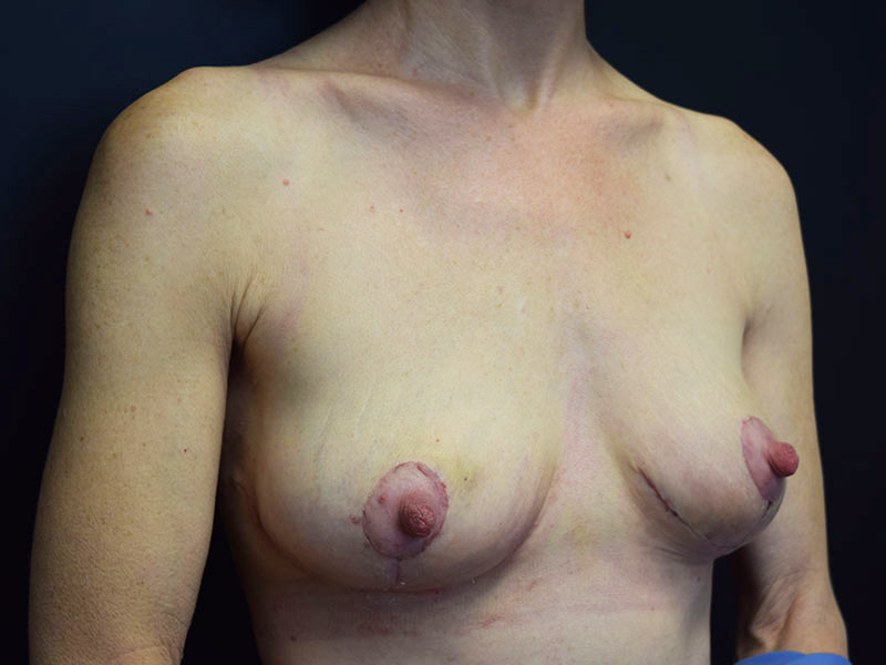 Breast Lift Before and After | Dr. Nadeau - Plastic and Reconstructive Surgeon