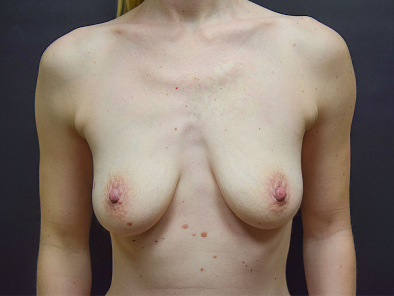 Breast Reconstruction Before and After | Dr. Nadeau - Plastic and Reconstructive Surgeon