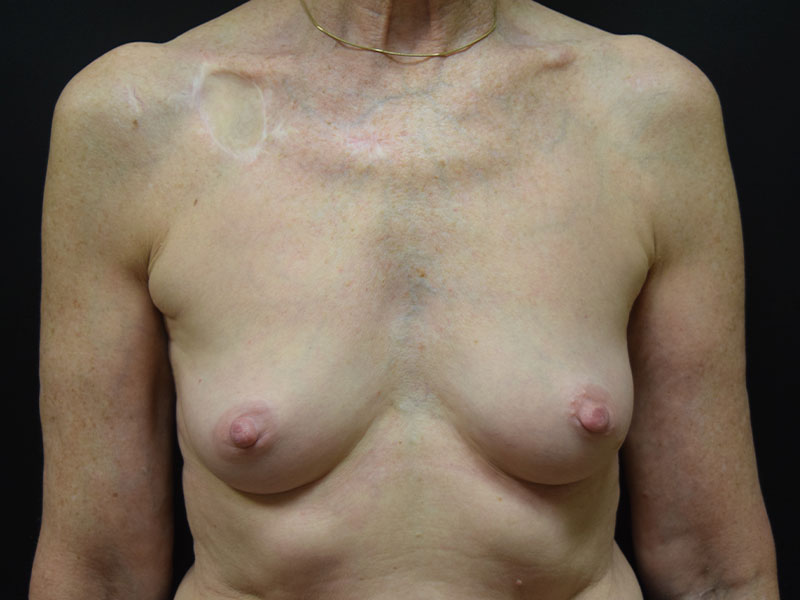 Breast Reconstruction Before and After | Dr. Nadeau - Plastic and Reconstructive Surgeon