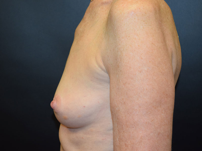 Breast Reconstruction Before and After | Dr. Nadeau - Plastic and Reconstructive Surgeon