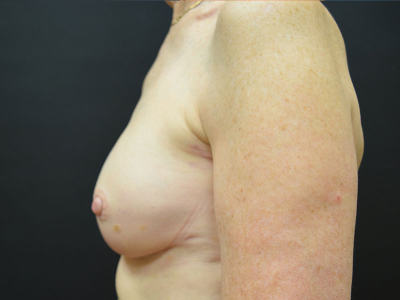 Breast Reconstruction Before and After | Dr. Nadeau - Plastic and Reconstructive Surgeon