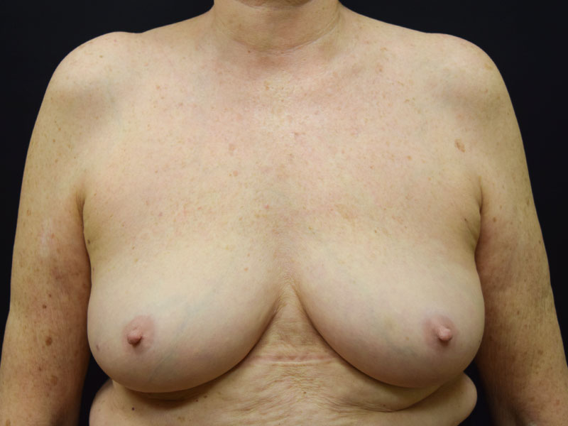 Breast Reconstruction Before and After | Dr. Nadeau - Plastic and Reconstructive Surgeon