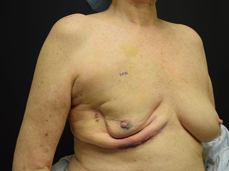 Breast Reconstruction Before and After | Dr. Nadeau - Plastic and Reconstructive Surgeon