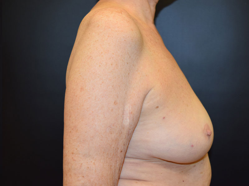 Breast Reconstruction Before and After | Dr. Nadeau - Plastic and Reconstructive Surgeon