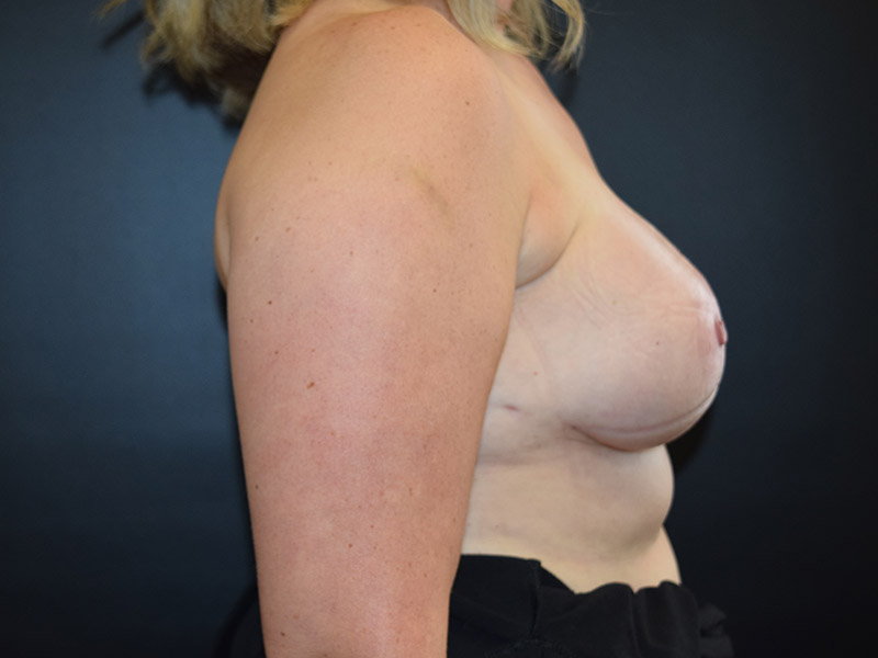 Breast Reconstruction Before and After | Dr. Nadeau - Plastic and Reconstructive Surgeon