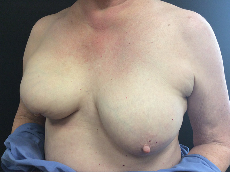 Breast Reconstruction Before and After | Dr. Nadeau - Plastic and Reconstructive Surgeon