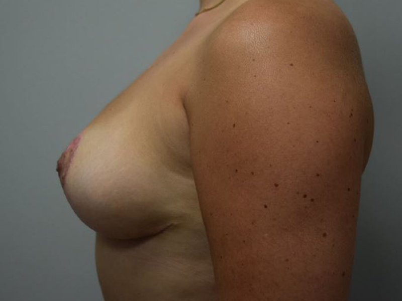 Breast Reduction Before and After | Dr. Nadeau - Plastic and Reconstructive Surgeon