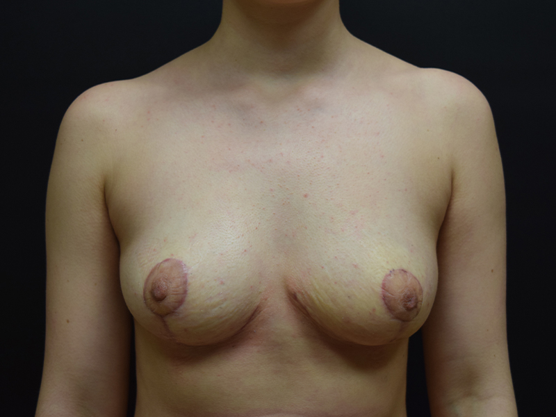 Breast Reduction Before and After | Dr. Nadeau - Plastic and Reconstructive Surgeon